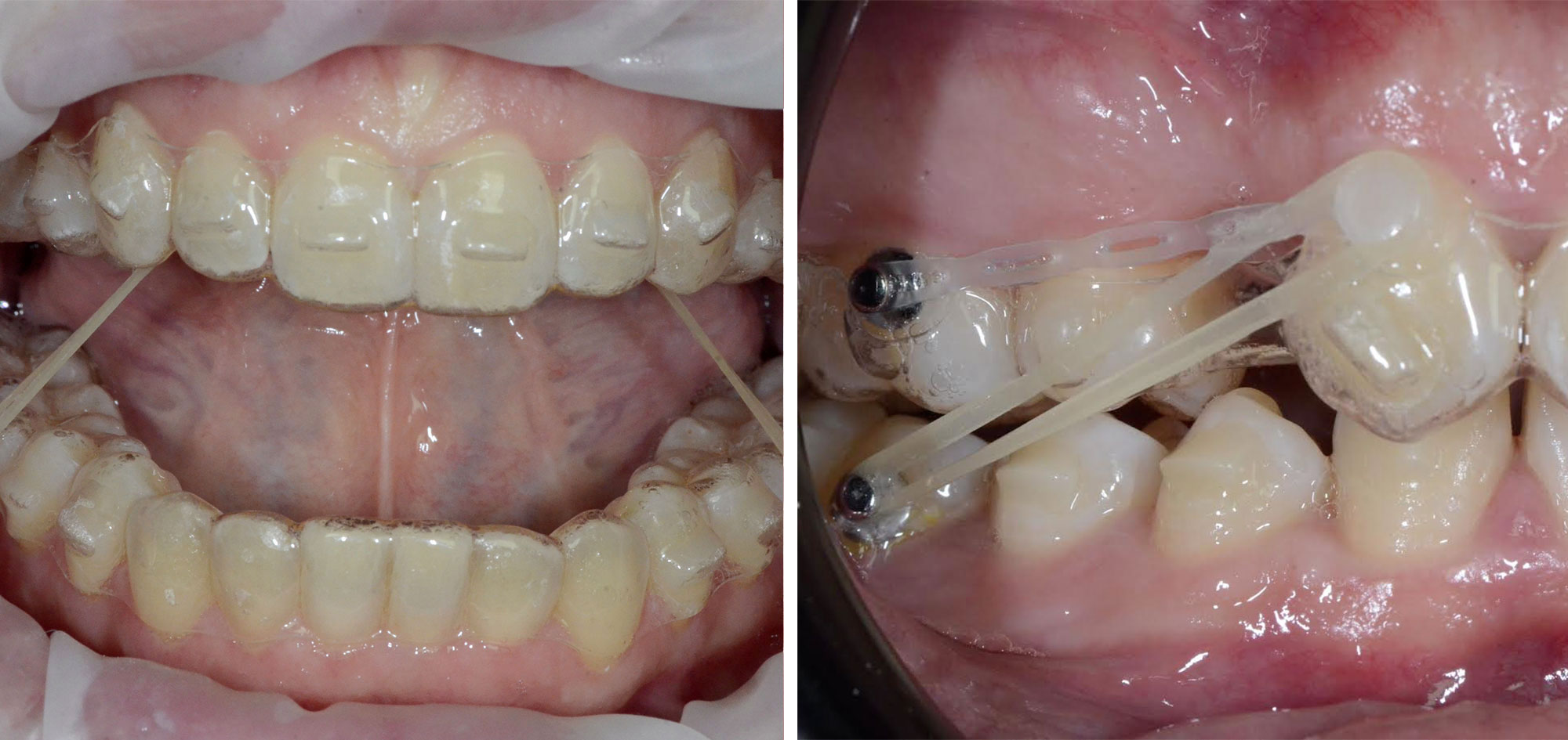 Orthodontie transparente Oberhausbergen Gouttières invisibles