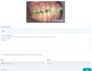 Dental monitoring - Dr Christophe Haus - Orthodontie Oberhausbergen