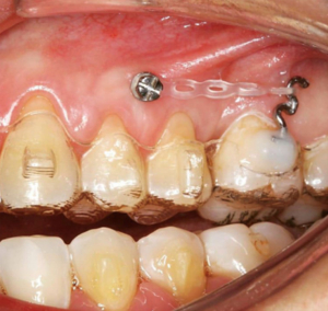 Mini vis Orthodontie invisible - Dr Christophe Haus - Orthodontie Oberhausbergen