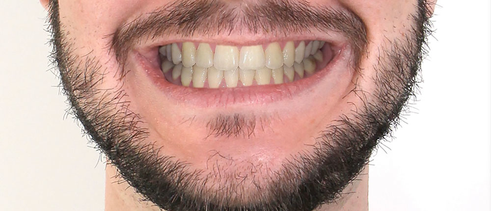 Homme sourire - Dr Christophe Haus - Orthodontie Oberhausbergen