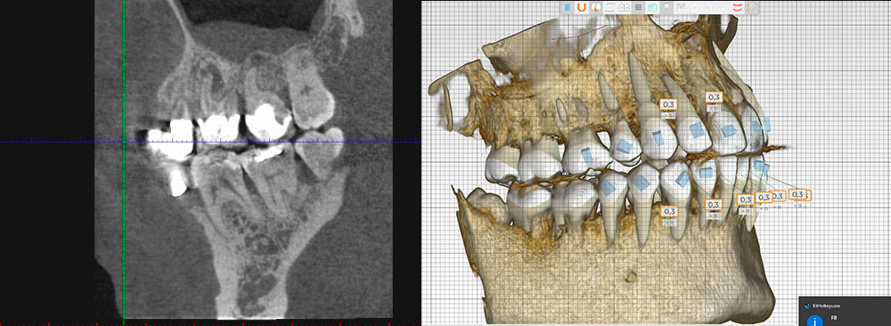 Orthodontie digitale - Dr Christophe Haus - Orthodontie enfant Oberhausbergen