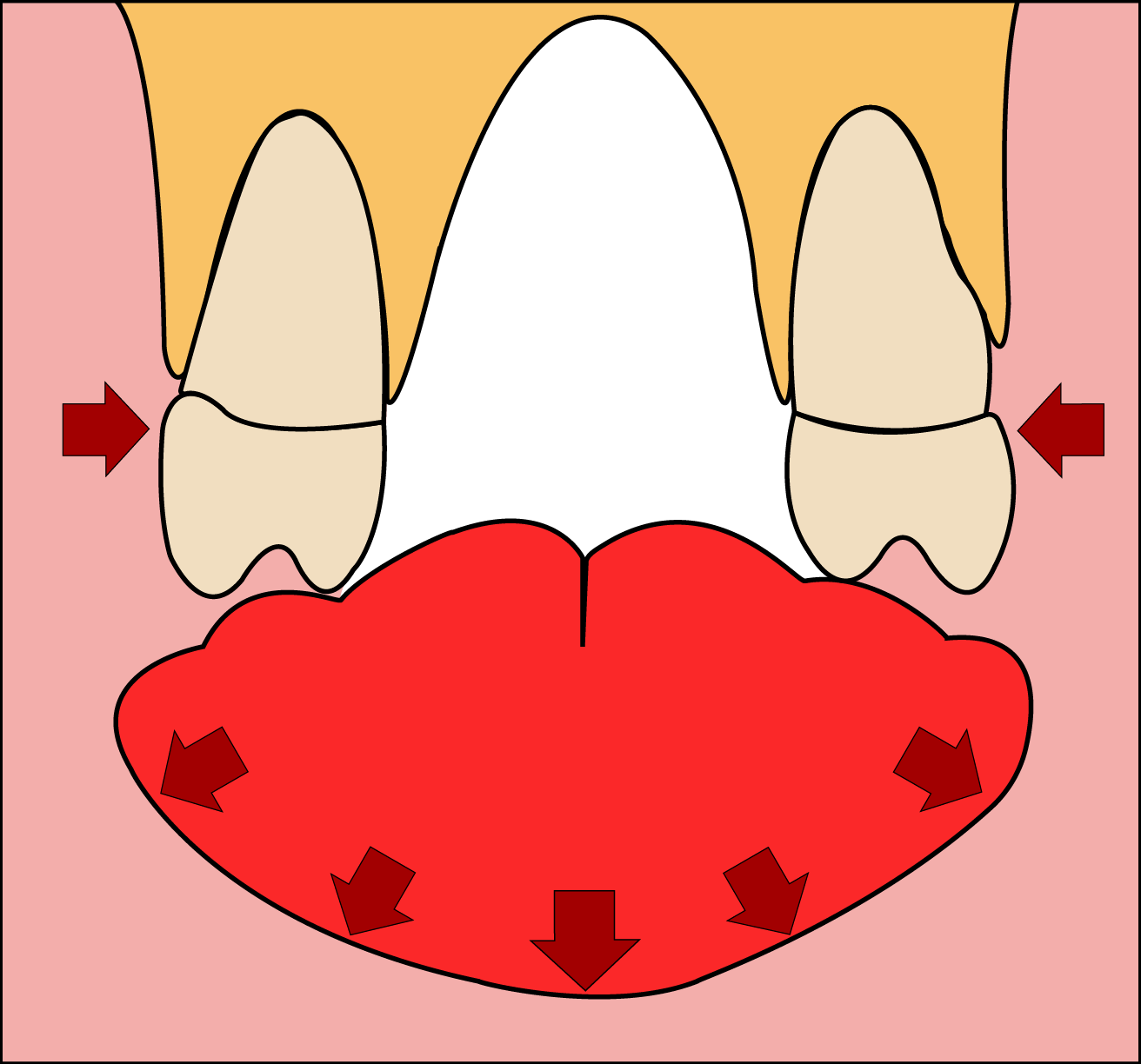 Orthodontie - Placement langue - Dr Christophe Haus - Orthodontie Oberhausbergen