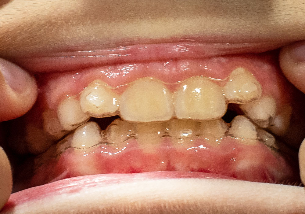Orthodontie précoce - Dr Christophe Haus - Orthodontie enfant Oberhausbergen